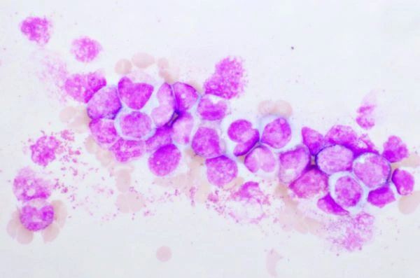 Leukemia